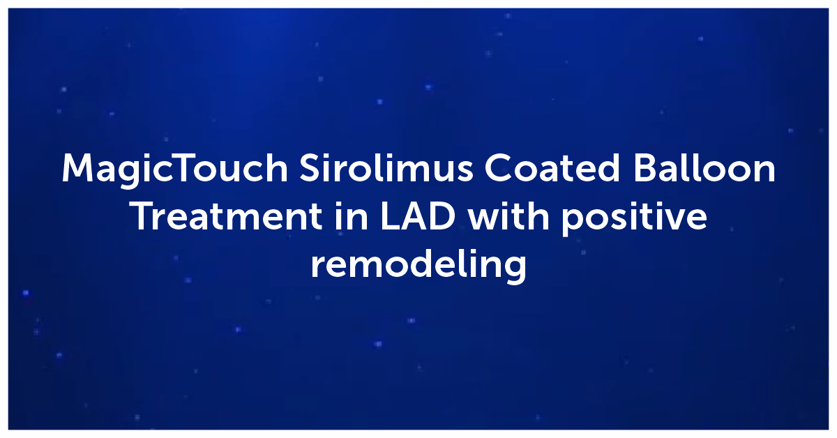 MagicTouch Sirolimus Coated Balloon Treatment in LAD with positive remodeling
