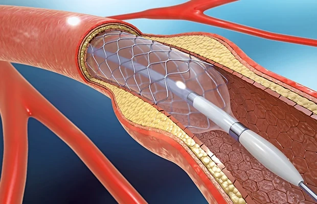 Coronary Artery Diseases (CAD) & Angioplasty